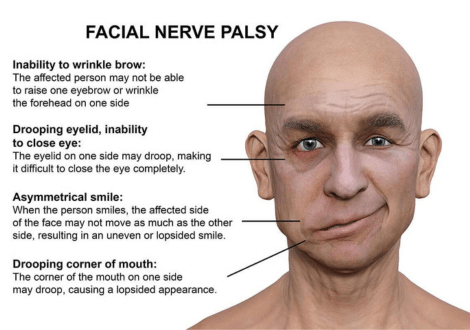 BELL’S PALSY