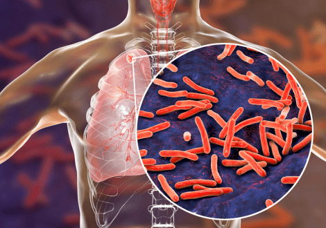 Understanding Tuberculosis (TB)